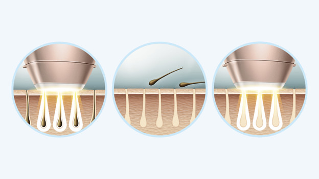 Qu'est-ce que l'épilation IPL ?