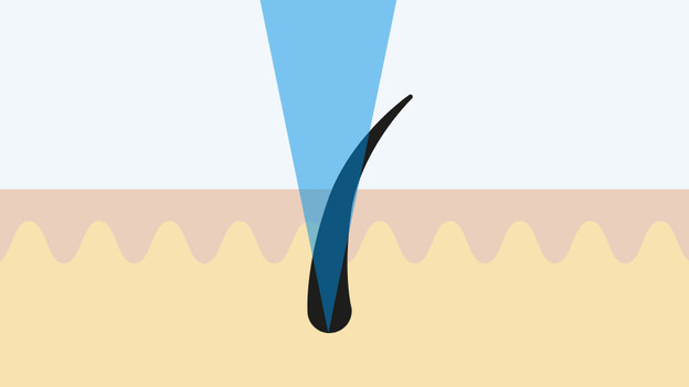 Faisceau laser direct