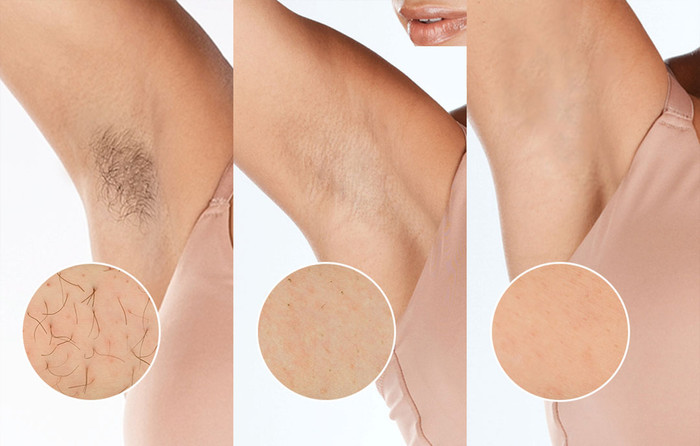 Philips Lumea IPL 9900 Series BRI951/01 visual leverancier